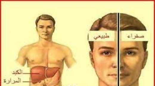 اليرقان.
