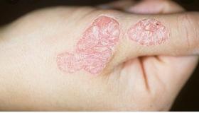 ما هو مرض الصدفية؟