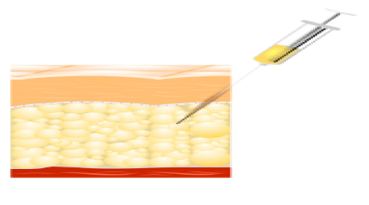 كيف يعمل شفط الدهون وما الآثار الجانبية له؟