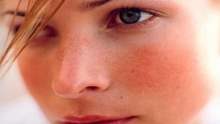 هناك ميزة تطورية لاحمرار الوجه .