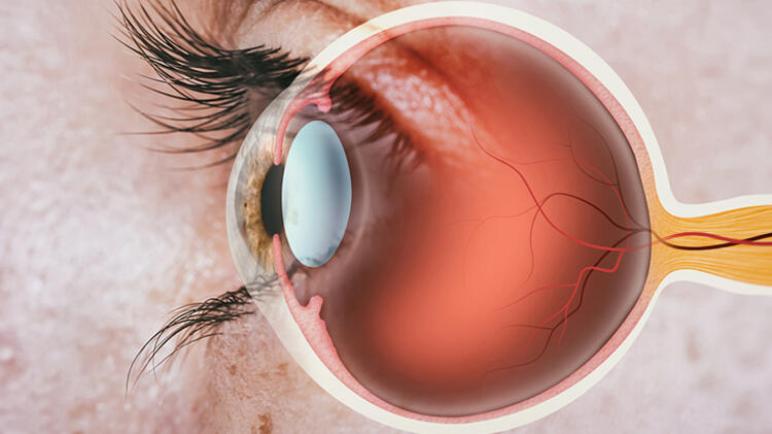 3 أمراض العيون التي قد تتطور بسبب مرض السكري وطرق العلاج.