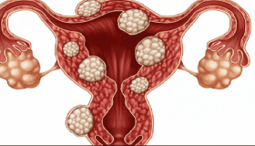 تكيس المبايض