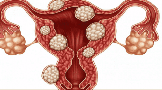 تكيس المبايض