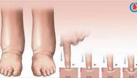 كيف أحارب احتباس السوائل؟