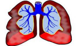 نقص الأكسجة