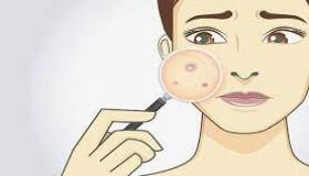 البشرة الدهنية