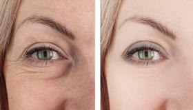 أفضل حل طبيعي للتجاعيد حول العينين.