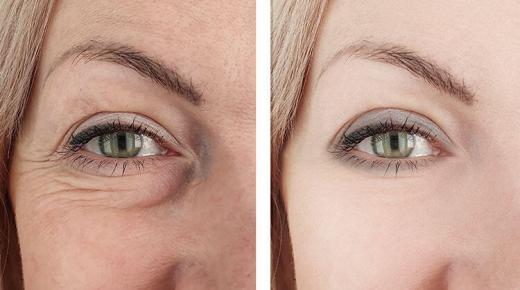 أفضل حل طبيعي للتجاعيد حول العينين.
