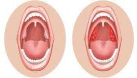 كيفية التمييز بين التهاب الحنجرة والتهاب البلعوم