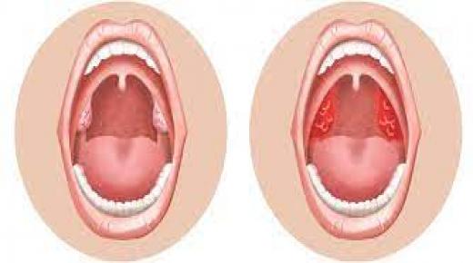 كيفية التمييز بين التهاب الحنجرة والتهاب البلعوم