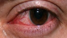 التهاب القرنية