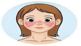 الذئبة الحمراء.