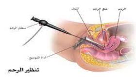 منظار الرحم: طريقة جديدة لفحص الرحم