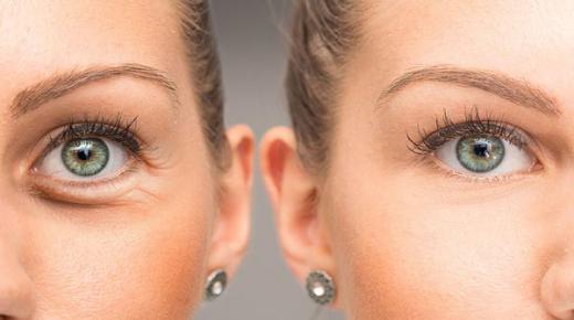 علاج انتفاخ العينين