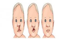 انشقاق الشفة