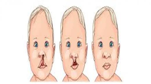 انشقاق الشفة