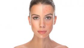 وصفة منزلية لقناع حب الشباب.