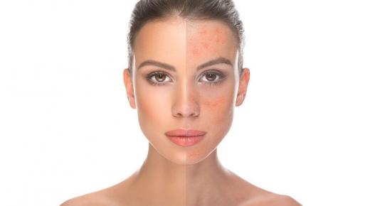 وصفة منزلية لقناع حب الشباب.