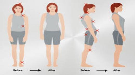 طرق لتصحيح تقوس الظهر: