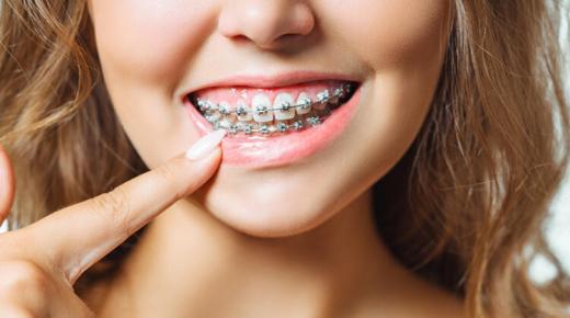 الخرافات حول الأقواس(تقويم الأسنان) التي يتم اعتبارها صحيحة.