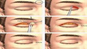 جراحة الجفن