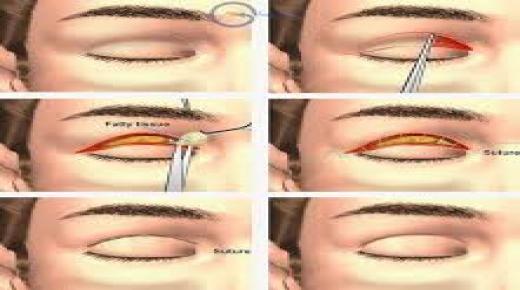 جراحة الجفن