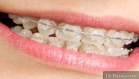 جهاز تقويم الأسنان غير المرئي