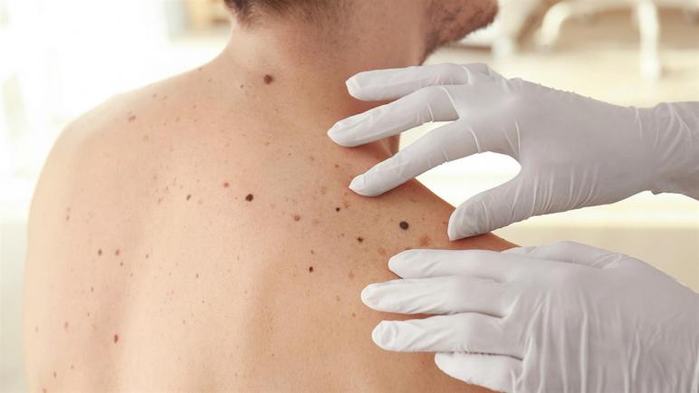 سرطان الجلد: ما هي السمات الخطيرة للحمة؟