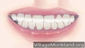 لماذا تطحن أسنانك بالليل وكيف توقفها