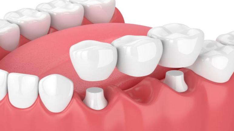 صحة الأسنان والجسور