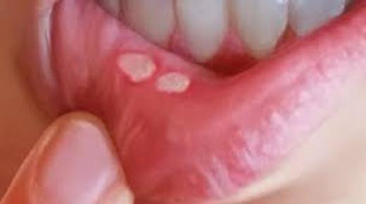 القلاع الفموي عند البالغين