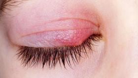 التهاب الجفن