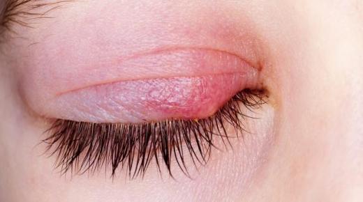 التهاب الجفن