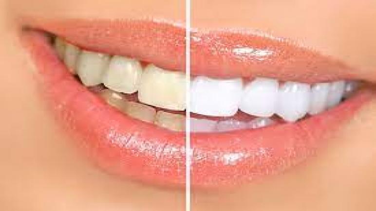 سبب تغير لون الاسنان