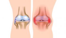 ما الذي يسبب التهاب المفاصل؟