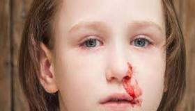لماذا تنزف أنوف الأطفال؟